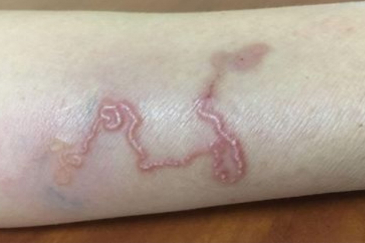 Thói quen ăn món tái sống khiến người đàn ông nhiễm 2 loại ký sinh trùng